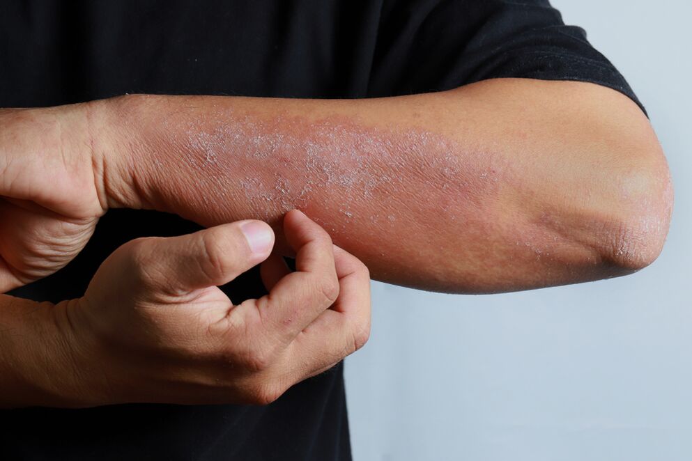 symptoms of psoriasis on the body