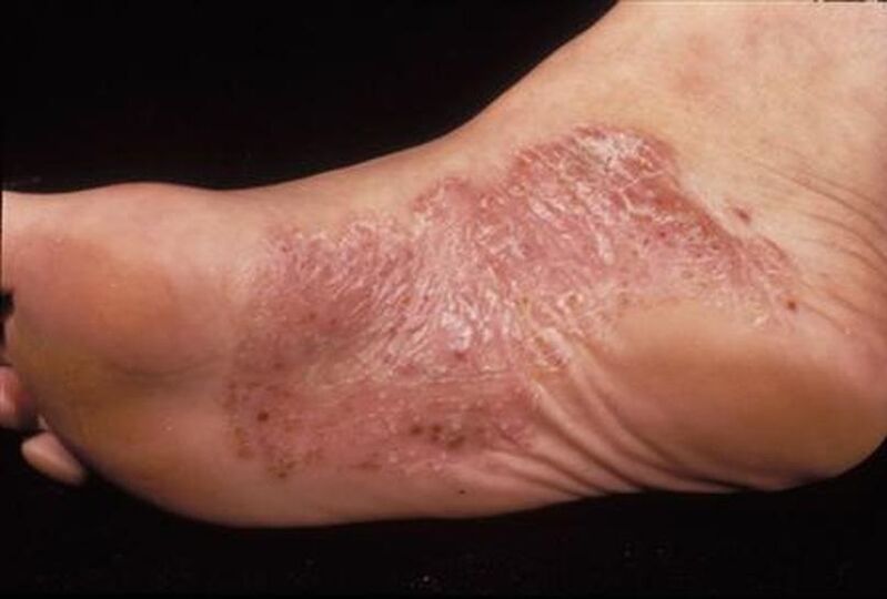 foot psoriasis symptoms