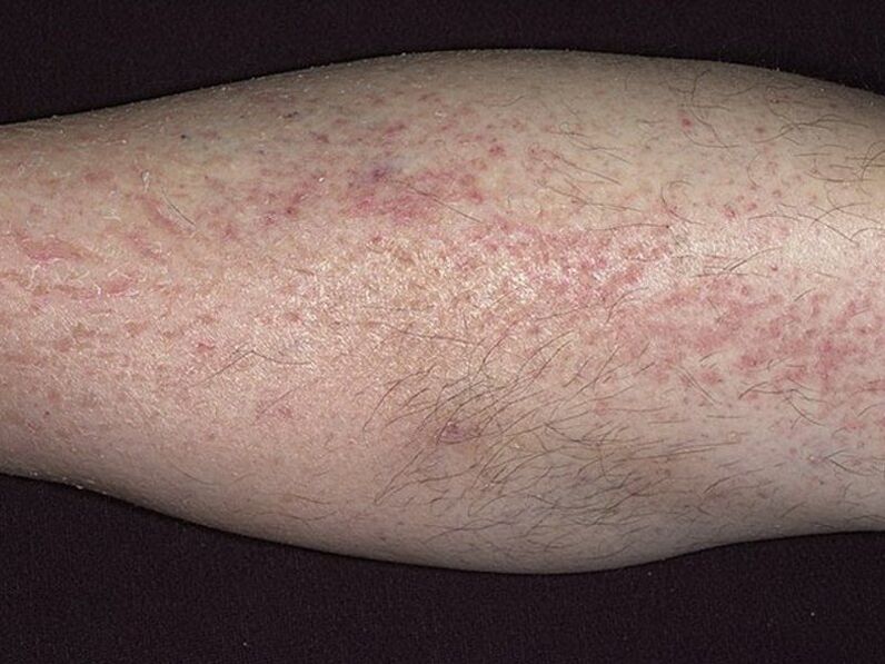 symptoms of leg psoriasis