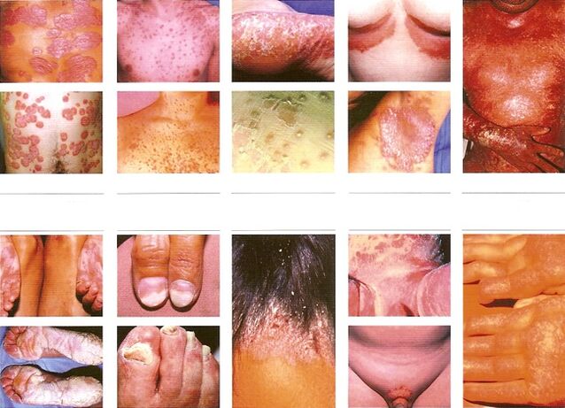 types of psoriasis on the body