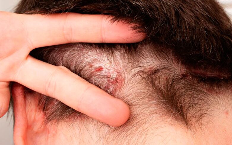 symptoms of psoriasis on the head