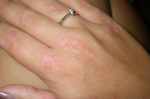 psoriasis on the hands