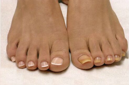psoriasis on the nails