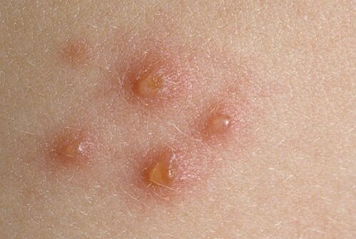 skin nodules in psoriasis