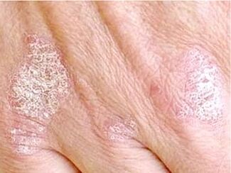 psoriasis on the skin