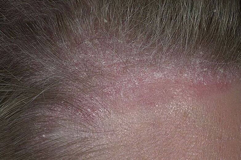 what scalp psoriasis looks like