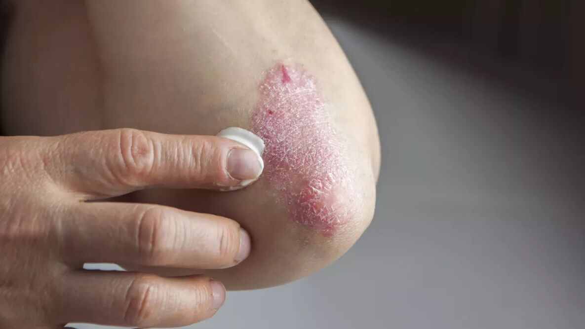 Psoriatic plaques on the elbow treated with medicated cream