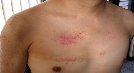 Psoriasis in the chest area