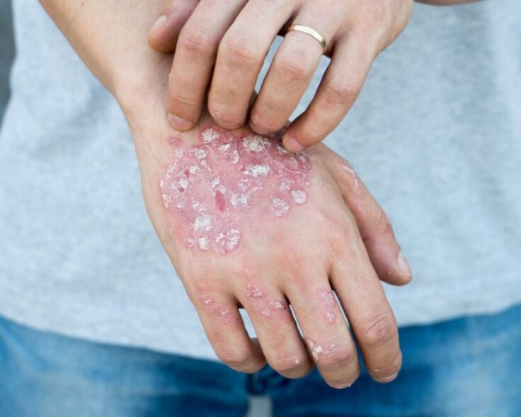 Psoriasis in the hands