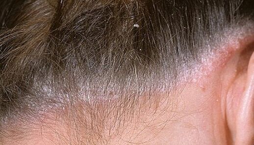 Psoriasis on the head