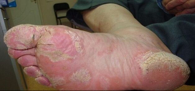 Psoriasis on the legs