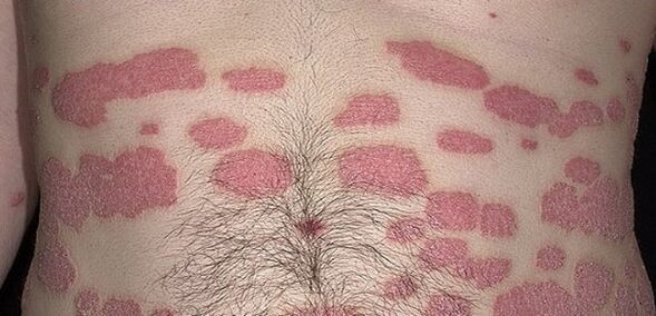 Psoriasis