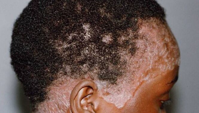 Psoriasis on the head
