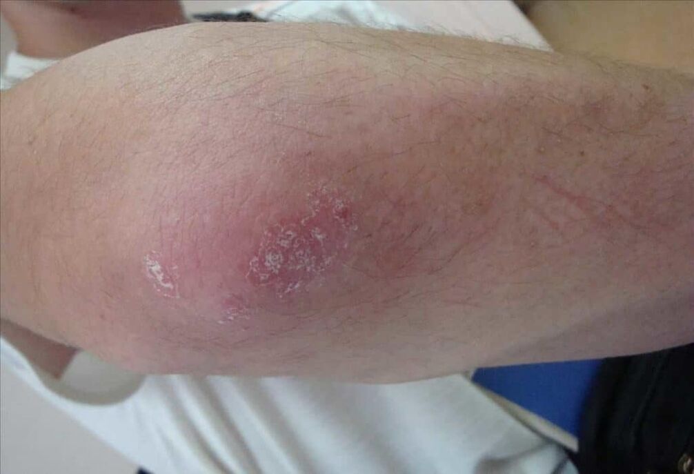 What a psoriasis does