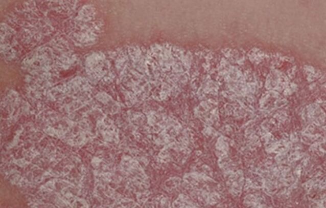 Healing of papules