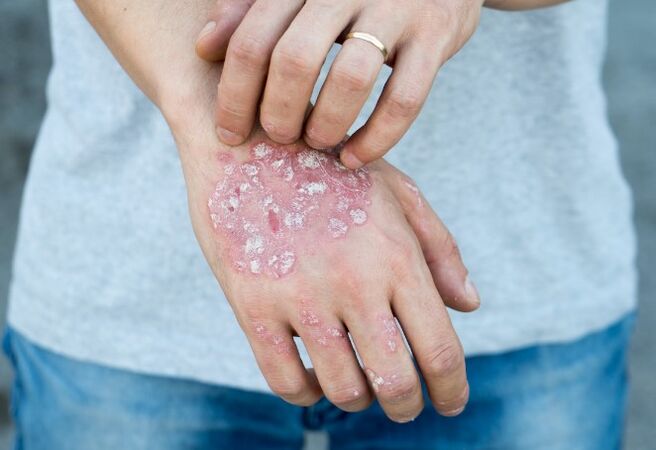 Mesnicherata psoriasis