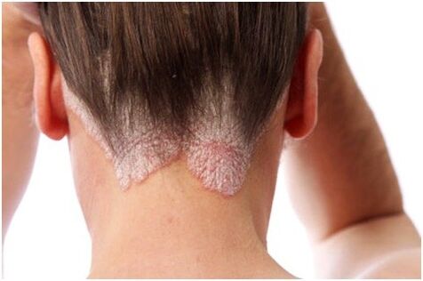 Psoriasis in the hair
