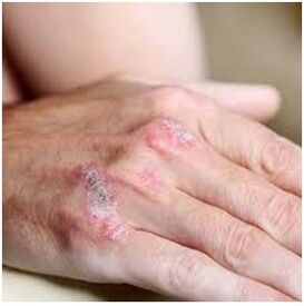 Psoriasis on the brush