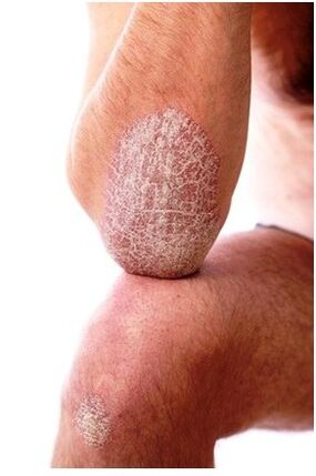 Psoriasis on the elbow