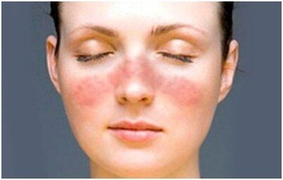 Psoriasis on the face