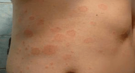 Unfortunate psoriasis