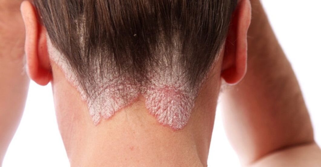 Psoriasis on the heads of the girls