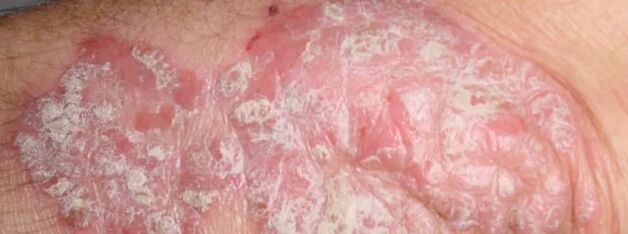 Mesnicherata psoriasis