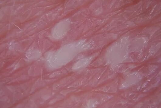 Pustullenia psoriasis