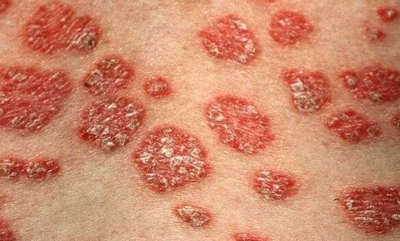 Forms of psoriasis
