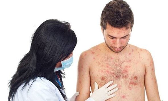 Photo of psoriasis