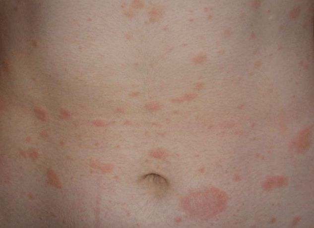 Regressive stage of psoriasis