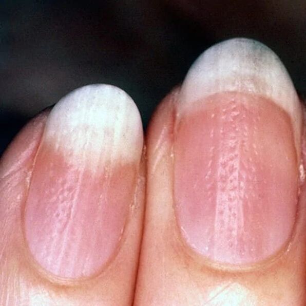 Nail psoriasis