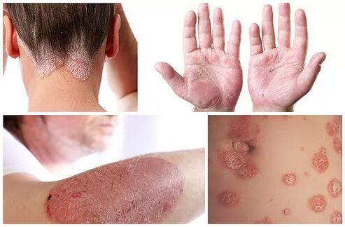Manifestations of psoriasis in different parts of the body