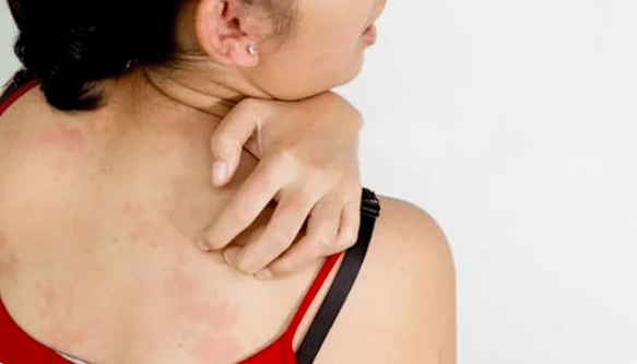 psoriasis