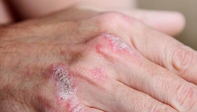 symptoms of the initial phase of psoriasis