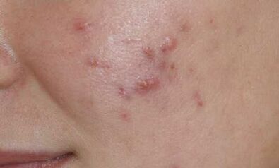 symptoms of the initial phase of psoriasis