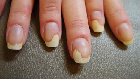 White spots on nails due to psoriasis