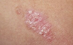 causes of psoriasis