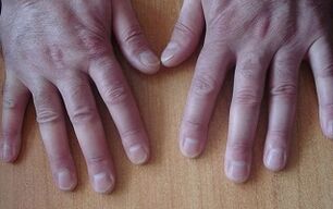 symptoms of psoriasis in the early stage