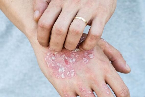 Characteristic symptoms of psoriasis on the hands