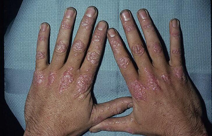 reasons for the development of psoriasis on the hands