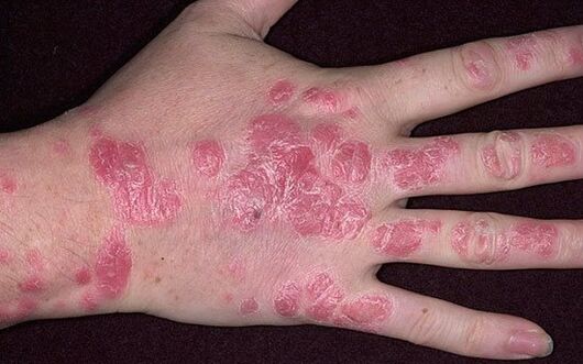 plaque psoriasis on the hands