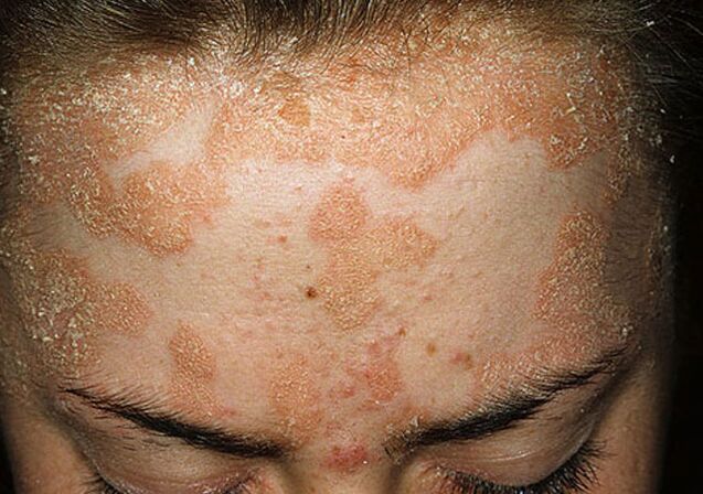 seborrheic psoriasis on the forehead