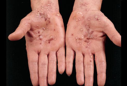 what psoriasis looks like on the palms of your hands