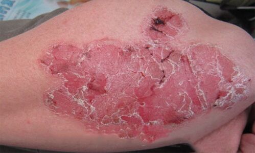 what pustular psoriasis looks like on the skin