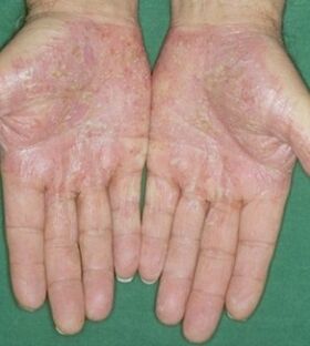 Psoriasis of the palms