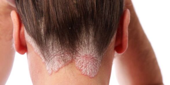 Well-defined papules on the scalp