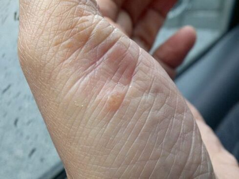 photo of psoriasis on the hand