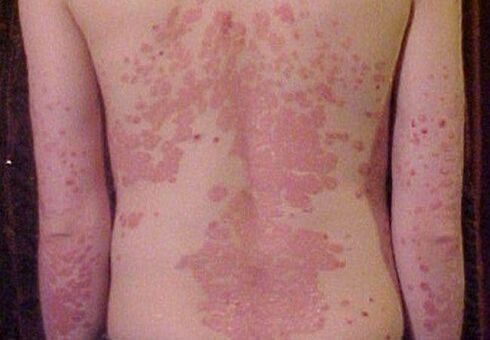 symptoms of psoriasis on the back