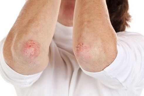 Manifestations of psoriasis on the elbows